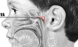 Viêm VA gây nhiều biến chứng