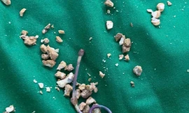 Suýt chết vì quên ống nhựa thông niệu quản trong người suốt 5 năm
