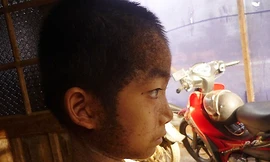 Bé trai 'tí hon' mọc sừng khắp người