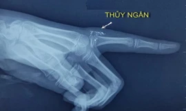 Những hạt thủy ngân trong tay qua hình ảnh phim X-quang. Ảnh: BVCC