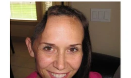 Cô Jamie Hilton và bức ảnh chụp cô bị khuyết một phần sọ