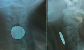 Quảng Bình: Phát hiện đồng xu nằm trong thực quản bé trai 5 tuổi