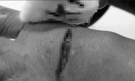 Một người bị con chó cắn bị thương