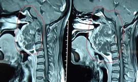 Khối u nằm vắt từ nền sọ xuống cột sống qua hình chụp x- quang. 