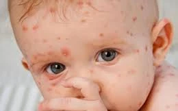 Trẻ sơ sinh bị thủy đậu do bà mẹ mang thai không tiêm vắc xin phòng bệnh