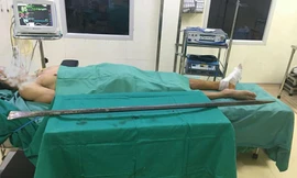  Bệnh nhân và chiếc xà beng đâm xuyên qua chân được các BS Bệnh viện E TƯ phẫu thuật lấy ra khỏi cơ thể.