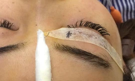 Cây kim phẫu thuật sau khi 'thất lạc' đã được lấy ra khỏi hốc mắt bệnh nhân. 