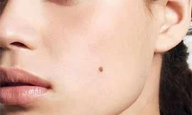 Ung thư từ nốt ruồi là loại rất nguy hiểm, phát triển nhanh, di căn nhanh, gây ung thư thứ phát ở gan, xương, phổi, não, hệ thống hạch...Ảnh minh hoạ: Internet