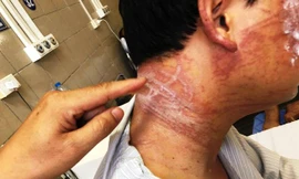 Các vết thương vẫn chằng chịt trên cơ thể người đàn ông sau 10 ngày bị sứa tấn công.