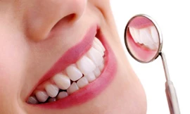 Có thể ung thư vì dùng thuốc tẩy trắng răng. Ảnh minh hoạ: Internet