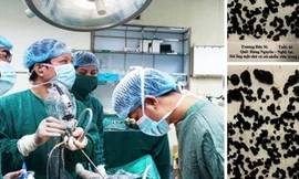 Nội soi lấy gần 1.000 viên sỏi đường mật trong gan bệnh nhân