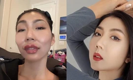 ‘Sốc’ nặng với siêu mẫu kỳ cựu khoe gương mặt sưng phồng vì mới đụng dao kéo