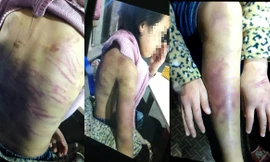 Những vết thương thâm tím, rỉ máu trên người cô bé 12 tuổi được cho bị chính mẹ ruột đánh đập