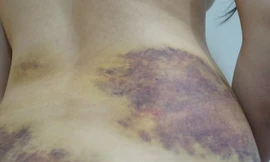 Vết thương trên cơ thể chị Sang. 