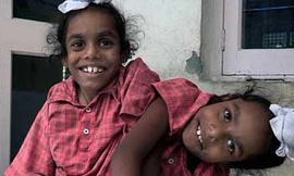 Chuyện kỳ lạ về cặp sinh đôi dính liền thân