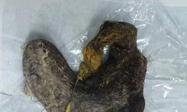 Lấy búi tóc nặng 700 gram trong bụng bé gái ‘nghiện ăn tóc’