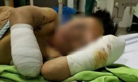Bé trai tám tuổi thương tích nặng, cụt hai tay sau tiếng nổ lớn