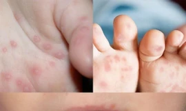 Ghi nhận bệnh nhi thứ 4 ở Đắk Lắk tử vong vì bệnh tay chân miệng