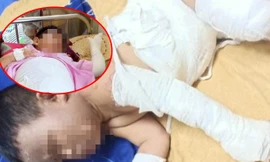 Bắt nhóm đối tượng phóng hỏa khiến 2 bé trai bỏng nặng