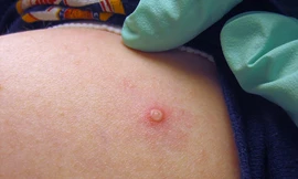 Bình Dương thông tin về ca bệnh đậu mùa khỉ đầu tiên vừa phát hiện