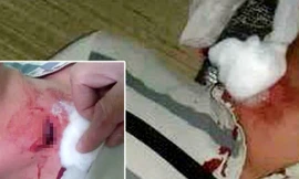 Nạn nhân bị vết thương ở cổ nghi viên đạn găm vào. Ảnh: VnExpress.