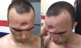 Jeremy bị lõm trán sau khi lĩnh trọn cú thúc cùi chỏ của đối thủ.