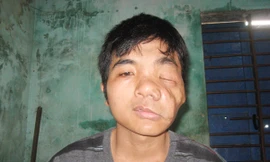 Khuôn mặt Tiến ngày càng biến dạng