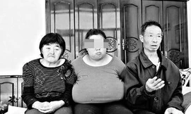 Cô gái có bộ ngực khổng lồ nặng đến 5kg