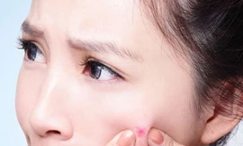 Khám miễn phí bệnh trứng cá