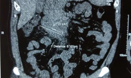 Người đàn ông ngủ quên, nuốt que tăm dài 6cm vào bụng