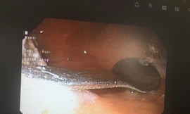 Hi hữu: Đi uống cà phê, cô gái 20 tuổi lỡ nuốt thìa sắt vào bụng