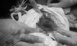 Sản phụ T. được cứu sống khi bị vỡ tử cung