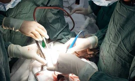 Người đàn ông bị gỗ đập vỡ tim