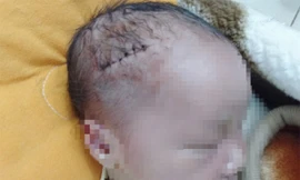 Bé trai mới sinh phải khâu 6 mũi do bác sĩ rạch trúng đầu khi mổ