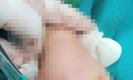 Hiếu kỳ đưa tay vào máy ép nước mía, bé 4 tuổi bị thương nặng