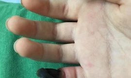 Bé 6 tuổi hoại tử ngón tay khi bôi thuốc trị mụn cóc mua trên mạng
