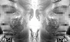 Chị H bị bỏng nặng ở vùng mặt và cổ. Ảnh: Báo Nghệ An