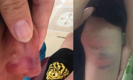 Giáo viên tiểu học khai nguyên nhân đánh con chồng nhập viện