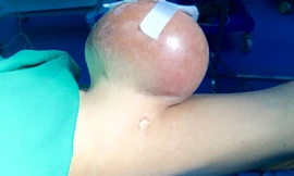 ‘Giải cứu’ người đàn ông mang khối u nặng 2kg suốt hàng chục năm