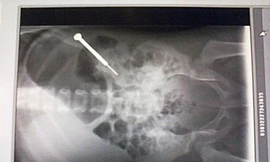 Bé gái 2 tuổi nuốt tua vít 9cm