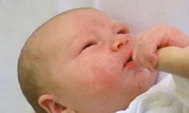 Bé bị chàm sữa do dính sữa mẹ?