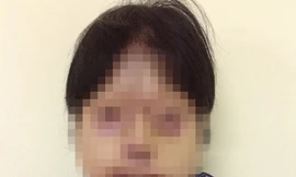 Tái tạo thành công mặt cho bệnh nhân bị tạt axít