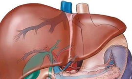 Vài điều nên biết về xơ gan