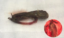 Lấy cuộn cước câu 'ở' trong niệu đạo nam thanh niên 11 năm