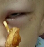 Hai trẻ bị … que xiên thức ăn chọc thủng mắt