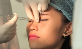 Tiêm filler tại spa, một thiếu nữ bị tổn thương thị lực