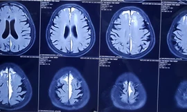 Bệnh nhân 71 tuổi đã hết liệt chân sau khi phẫu thật não bằng gây tê