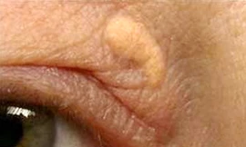 Nhìn mí mắt đoán nguy cơ đau tim