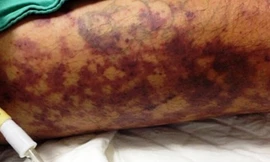 Phát hiện thêm ca mắc liên cầu lợn tại Thừa Thiên-Huế