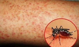 TT-Huế có trường hợp tử vong đầu tiên do sốt xuất huyết, số ca mắc tăng gấp 7 lần